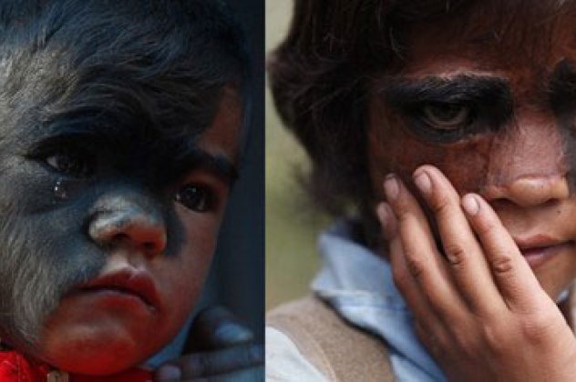 Η μεταμόρφωση του κοριτσιού από το Νεπάλ που έπασχε από το «σύνδρομο του λύκου» - Κυρίως Φωτογραφία - Gallery - Video