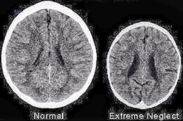 Απίστευτη φωτογραφία - Πως είναι ο εγκέφαλος ενός παιδιού που δεν μεγαλώνει με αγάπη! - Κυρίως Φωτογραφία - Gallery - Video