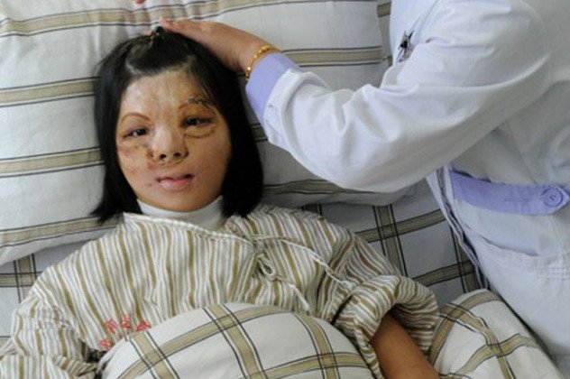 Κινέζοι γιατροί έκαναν το θαύμα τους! Πρόσφεραν καινούριο πρόσωπο στην Ζου Τζιανμέι το οποίο είχαν εμφυτεύσει αρχικά στο στήθος της! (φωτό) - Κυρίως Φωτογραφία - Gallery - Video