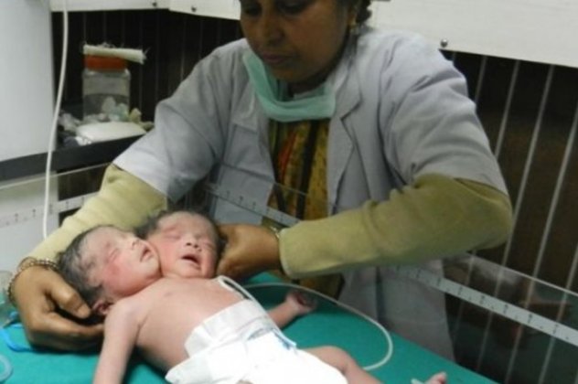 Μωρό με δύο κεφάλια γεννήθηκε στην Ινδία! (φωτό & βίντεο) - Κυρίως Φωτογραφία - Gallery - Video