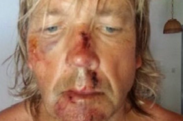 Βρετανός τουρίστας καταγγέλει με θυμό όσα του συνέβησαν στη Σκιάθο και δειχνει πώς κατάντησε το πρόσωπό του! (φωτό) - Κυρίως Φωτογραφία - Gallery - Video