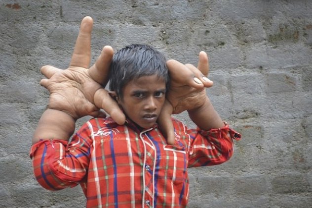 Απίστευτο: Αυτό το 8χρονο αγόρι από την Ινδία έχει χέρια που ζυγίζουν 12,5 κιλά (φωτό) - Κυρίως Φωτογραφία - Gallery - Video