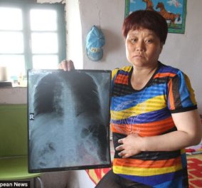 Story: Η απίστευτη ιστορία της Κινέζας Alatan Hsia - Της έκαναν ακτινογραφία και δείτε τι ανακάλυψαν...