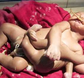 Ινδία: Μωρό με... 8 πόδια, θεωρείται μετενσάρκωση θεού επί της Γης - Το ονόμασαν «Αγόρι Θεό» και μιλούν για θαύμα!