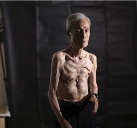 Φρικιαστικά σημάδια στην πλάτη του επιζώντα της πυρηνικής επίθεσης στο Ναγκασάκι - Σάπισαν τα πλευρά του & δεν αναπνέει 