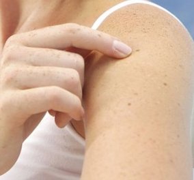 Έρευνες αποκαλύπτουν: Περισσότερες από 11 ελιές στο μπράτσο αυξάνουν τον κίνδυνο για καρκίνο του δέρματος 