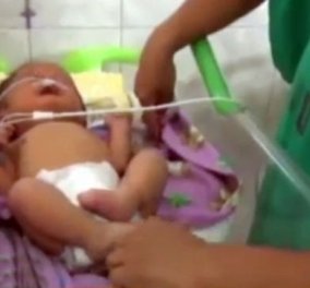 Βίντεο: Μωρό -αγγελούδι ο Angelito γεννήθηκε με δύο «σωληνάκια» αντί για μύτη 
