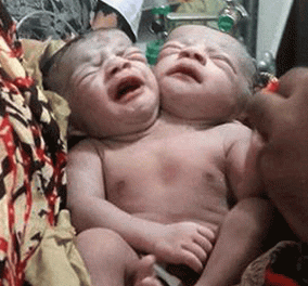 Κοριτσάκι με 2 κεφάλια γεννήθηκε στο Μπαγκλαντές - Παραμένει στην εντατική λόγω αναπνευστικών προβλημάτων