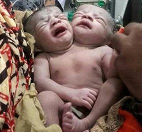 Ένα ή δύο μωρά; Βρέφος με δύο κεφάλια γεννήθηκε στο Μπαγκλαντές -(φώτο) 