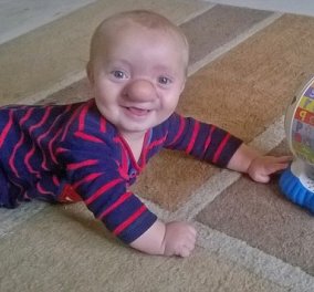 Μωρό πινόκιο: Η μύτη του μεγαλώνει σαν μπάλα του γκόλφ λόγω σπάνιας πάθησης   