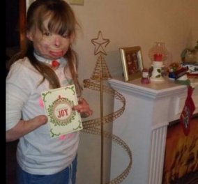 Παγκόσμια συγκίνηση για το 8χρονο ορφανό κοριτσάκι που παραμορφώθηκε σε φωτιά -Ζητάει Χριστουγεννιάτικες κάρτες  