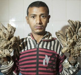 Η συγκινητική ιστορία του 25χρονου Abul: Μέρα με τη μέρα μετατρέπεται σε δέντρο λόγω σπάνιας πάθησης