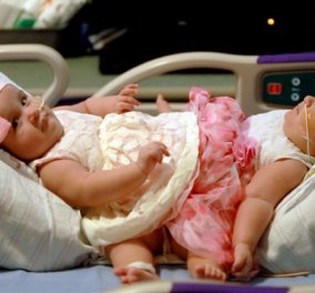 Διαχωρίστηκαν σιαμαία κοριτσάκια που γεννήθηκαν από τρίδυμη κύηση: 15 ώρες ο τοκετός -  Φώτο