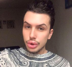 22χρονος έχει δώσει 26.000 ευρώ για να μοιάσει στην Κιμ Καρντάσιαν - Σκοπός του να γίνει ''πλαστικός & ψεύτικος''