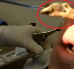 Αν το αντέχετε δείτε το βίντεο: Ο γιατρός βγάζει από τη μύτη του κυρίου ένα "βατράχι"