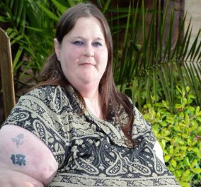 Η ιστορία της 34χρονης Annette που ζει σε αναπηρικό καροτσάκι λόγω του βάρους του στήθους της 