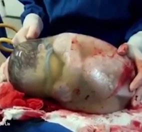 Βίντεο: Μωράκι γεννήθηκε μέσα στον αμνιακό σάκο - Συμβαίνει μόνο 1 φορά ανά 80.000 βρέφη