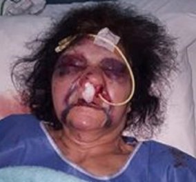 Συγκλονιστική φωτό: 80χρονη έπεσε θύμα άγριου ξυλοδαρμού στη Ρόδο - Τι καταγγέλλει ο γιος της