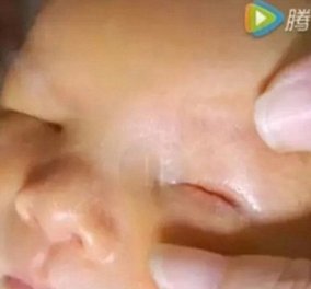 Συγκλονιστικό story: Μωράκι γεννήθηκε χωρίς μάτια - Συμβαίνει 1 φορά στις 100.000