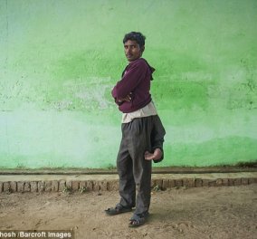 Ελπίδα για έναν 22χρονο από την Ινδία που γεννήθηκε με 2 επιπλέον πόδια στην πλάτη (βίντεο) 