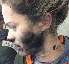 Συνταρακτική εικόνα: Κάηκε το πρόσωπο της όταν εξεράγησαν τα ακουστικά της μέσα στο αεροπλάνο 