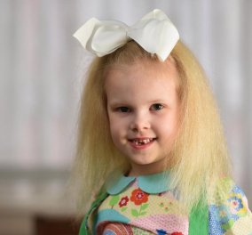 Story of the day : Κοριτσάκι - "Αϊνστάιν" πάσχει από «Σύνδρομο Αχτένιστων Μαλλιών», μία σπάνια ασθένεια