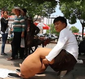  150 κιλά ζυγίζουν τα πόδια 26χρονου από μόλυνση με σκουλήκια που μπήκαν στο αίμα του -Φώτο & Βίντεο