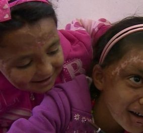 Η Ραχάφ & η Καμάρ δυο μικρούλες κάηκαν & ασχήμυναν: "Θέλω να γίνω όμορφη ξανά" λένε στο BBC