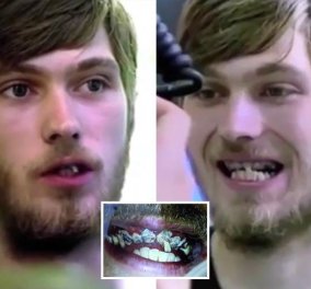 Βίντεο που κόβει την ανάσα: Να πώς θα γίνουν τα δόντια σας αν δεν τα βουρτσίζετε για 20 χρόνια (Βίντεο)