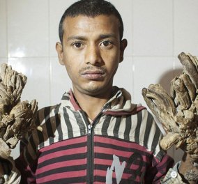 Για την 26η εγχείρηση στο νοσοκομείο ο 28χρονος άνθρωπος  - δέντρο  από το Μπαγκλαντές – Χειροτέρευσε η κατάστασή του