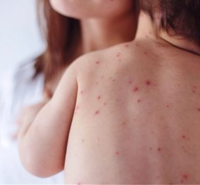 Σκληρό μέτρο για ανεμβολίαστα παιδιά – Το αντιεμβολιαστικό κίνημα & η μεγάλη επιδημία 