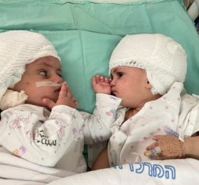 Ισραήλ: Σιαμαία κοριτσάκια κοιτάζονται για πρώτη φορά μετά από επέμβαση «ζωής ή θανάτου» - ήταν ενωμένα τα κεφαλάκια τους (βίντεο)