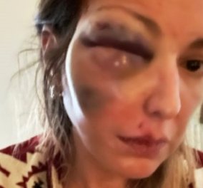 Στεφανία Τζαφέρη: Θύμα κακοποίησης γνωστή food blogger από την Κρήτη - σοκάρει η εικόνα της από τον ξυλοδαρμό