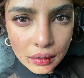 H Priyanka Chopra με μελανιες & αίματα στο πρόσωπο: «Είχε κάποιος άλλος μια δύσκολη μέρα στη δουλειά;» (φωτό)