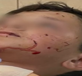 Λαγονήσι: Με σοβαρά τραύματα 13χρονος που δέχθηκε άγρια επίθεση από σκύλο φύλακα (βίντεο)