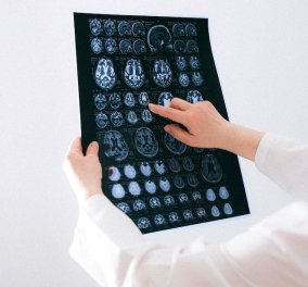 Εγκεφαλικό: Η «έξυπνη» εφαρμογή που αναγνωρίζει τα συμπτώματα – Σε πραγματικό χρόνο στο κινητό σας