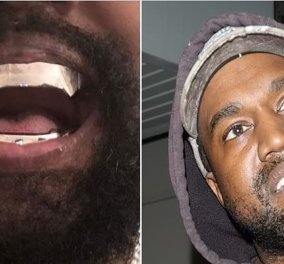 Ο Kanye West αφαίρεσε όλα τα δόντια του και τα αντικατέστησε με οδοντοστοιχία από τιτάνιο! Λαμπυρίζουν το βράδυ μπρρρρρρ (βίντεο) - Κυρίως Φωτογραφία - Gallery - Video