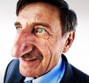 Δείτε τον άνθρωπο με την πιο μακριά μύτη στον κόσμο !!! Είναι Τούρκος και η μυτούλα του 8,8 - Κυρίως Φωτογραφία - Gallery - Video