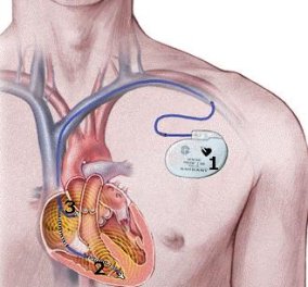 Βηματοδότης χωρίς μπαταρία θα τροφοδοτείται με ρεύμα από τους χτύπους της καρδιάς 