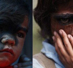 Η μεταμόρφωση του κοριτσιού από το Νεπάλ που έπασχε από το «σύνδρομο του λύκου» - Κυρίως Φωτογραφία - Gallery - Video