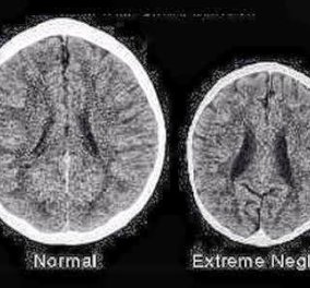Απίστευτη φωτογραφία - Πως είναι ο εγκέφαλος ενός παιδιού που δεν μεγαλώνει με αγάπη! - Κυρίως Φωτογραφία - Gallery - Video