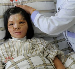 Κινέζοι γιατροί έκαναν το θαύμα τους! Πρόσφεραν καινούριο πρόσωπο στην Ζου Τζιανμέι το οποίο είχαν εμφυτεύσει αρχικά στο στήθος της! (φωτό) - Κυρίως Φωτογραφία - Gallery - Video