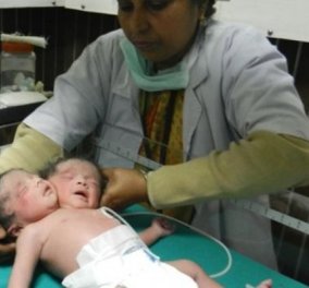 Μωρό με δύο κεφάλια γεννήθηκε στην Ινδία! (φωτό & βίντεο) - Κυρίως Φωτογραφία - Gallery - Video