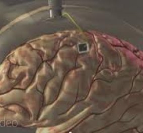 23χρονος τετραπληγικός κουνά και πάλι το χέρι του χάριν σε εμφυτευμένο τσιπ στον εγκέφαλο του: Δείτε το βίντεο  - Κυρίως Φωτογραφία - Gallery - Video