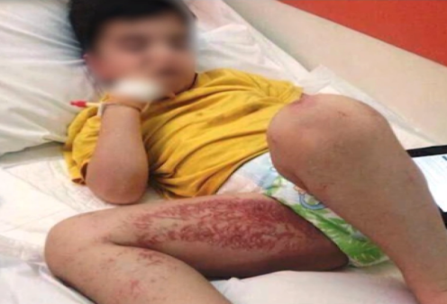 Ναύπλιο: Στο νοσοκομείο παιδί που ακούμπησε θαλάσσια ανεμώνη - Πόσο επικίνδυνες είναι, τι πρέπει να κάνετε αν σας «χτυπήσουν» (βίντεο)